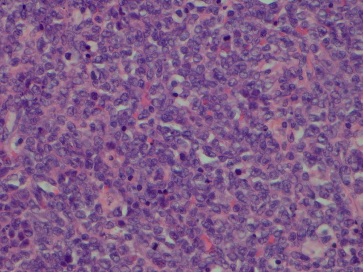 Small bowel myeloid sarcoma (H&E 400X)